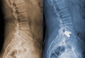 getty_rm_photo_of_post-operative_spine_x-ray